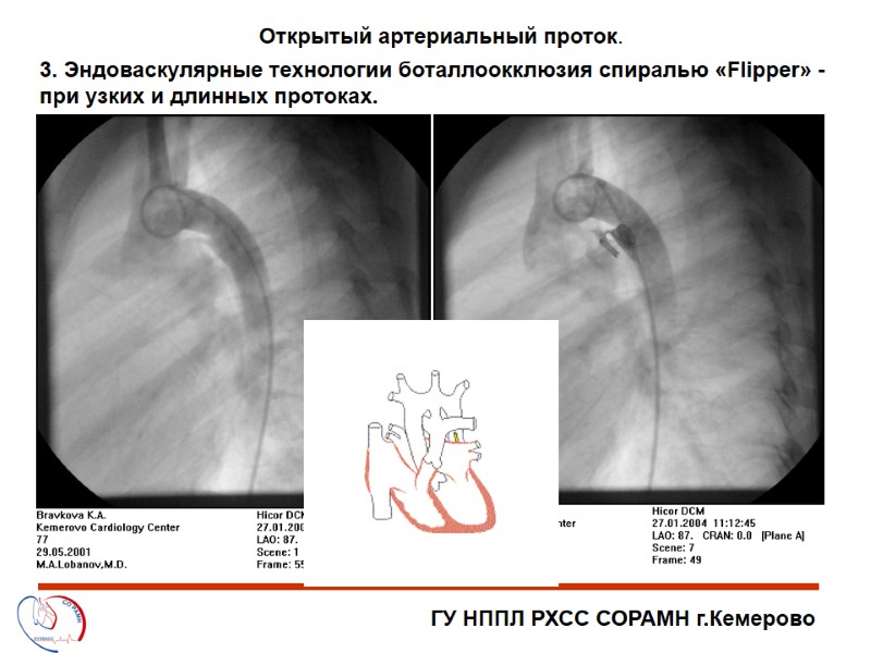 ГУ НППЛ РХСС СОРАМН г.Кемерово Открытый артериальный проток. 3. Эндоваскулярные технологии боталлоокклюзия спиралью «Flipper»